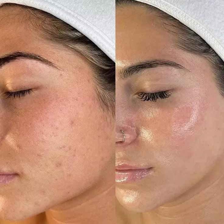 Softens acne breakouts